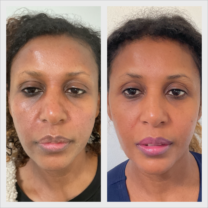 Before and after skin treatment, front view of a Derma Radiance patient